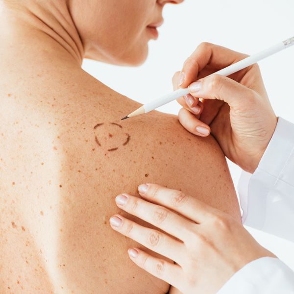 cancer cutané, mélanome, lésion de la peau : chirurgie dermatologique auprès du docteur Marie Tourrier